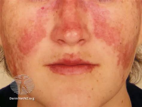 Psoriasis Vs Lupus Photos And Signs To Tell The Difference