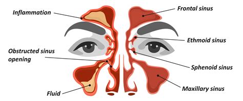 Nasal Congestion Anatomy