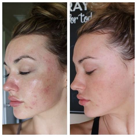 Beforeleft And 5 Days After Right Microneedling With Prp Schnell