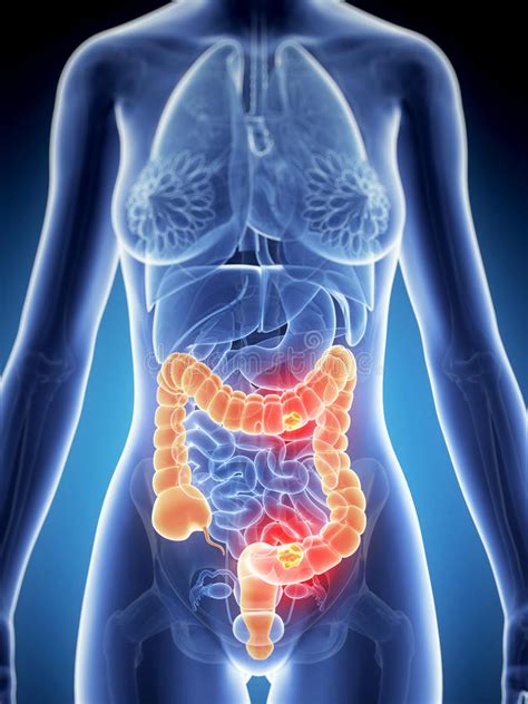 To correct this, simply remove the colon. Female colon - cancer stock illustration. Illustration of ...