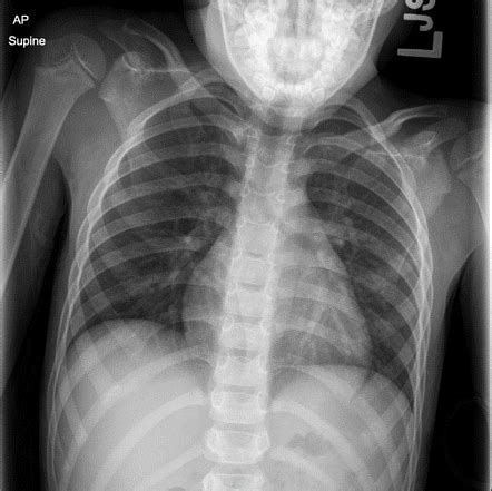 Normal Chest Radiograph Pediatric Radiology Case Radiopaedia Org