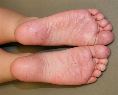 Enfermedades Dermatol Gicas De Los Pies Causadas Por El Calzado