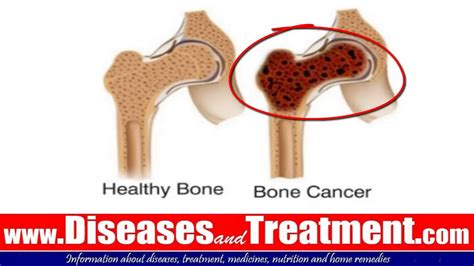 Bone Cancer Overview Causes Diagnosis Symptoms Treatment