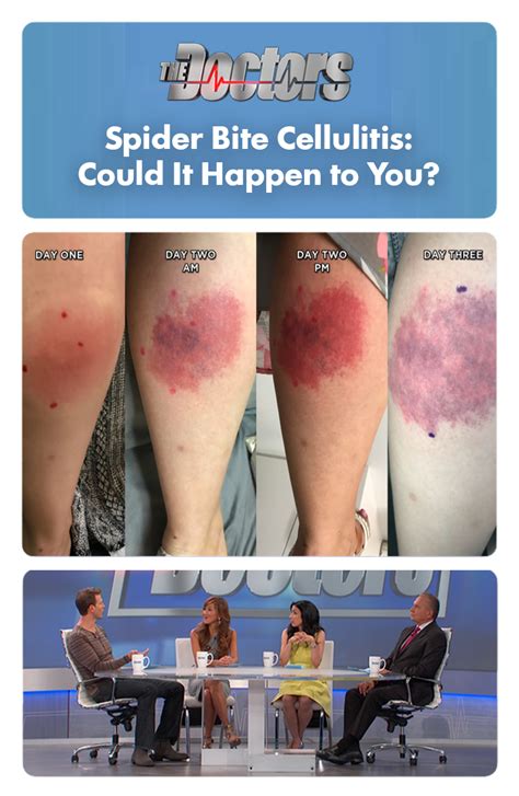 Can A Spider Bite Cause Cellulitis Cellulitis Infection Bug Bite