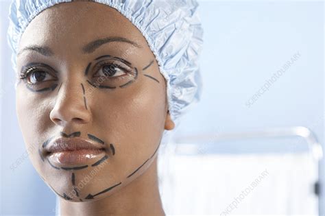 Facelift Surgery Markings Stock Image F0025145 Science Photo Library