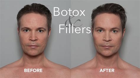 Non Surgical Botox And Filler Injections For Men Cheeks Chin And Forehead