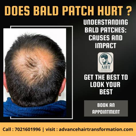 Does Bald Patch Hurt Understanding Bald Patches Causes And Impact