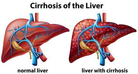 Liver Cirrhosis Causes Symptoms Diagnosis Treatment Max Clbs