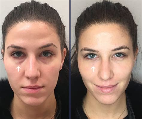 Under Eye Fillers For Dark Circles Efficacy Photos Cost Side