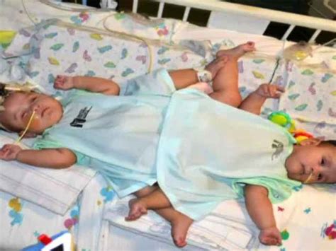 Surgery Separates Infant Conjoined Twins