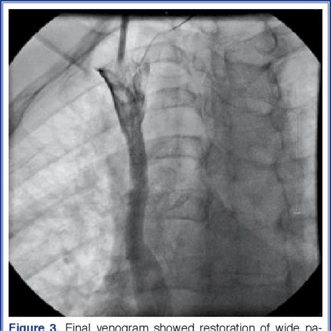 Figure 3 From Percutaneous Treatment Of Superior Vena Cava Syndrome