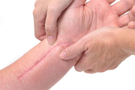 Treating Scar Tissues Using The Graston Technique Midtown Therapists Share Its Benefits