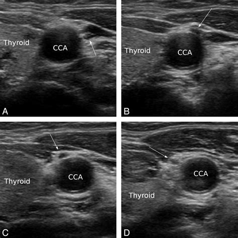 Variations In The Course Of The Cervical Vagus Nerve On Thyroid