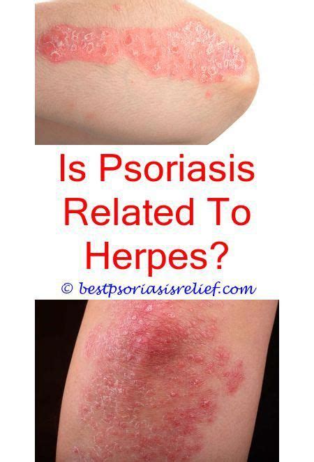 Ispsoriasisitchy Psoriasis Red Dots Erythrodermic Psoriasis Home
