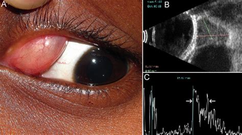 Respiratory Choristomatous Cyst Of The Conjunctiva Canadian Journal