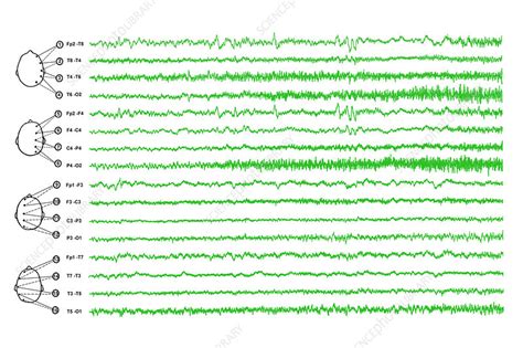 Brain Waves In Epilepsy Stock Image M150 0284 Science Photo Library