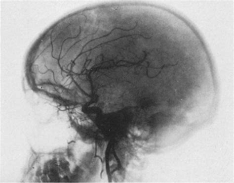 Egas Moniz And Cerebral Angiography In Journal Of Neurosurgery Volume