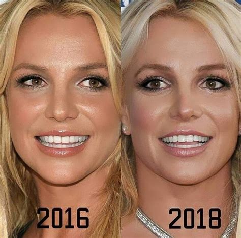 britney spears teeth before after