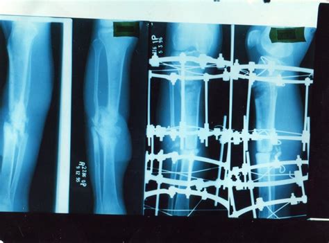 Outcomes Of Ilizarov Ring Fixation In Recalcitrant Infected Tibial Non