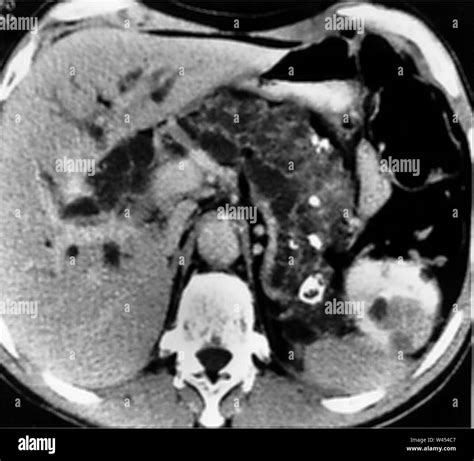 Complete Replacement Of The Pancreas With Cystic Disease And