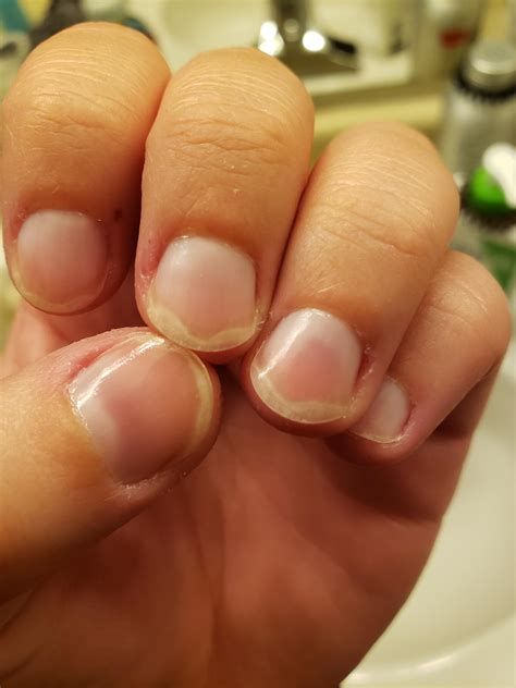 Question Whites Of My Nails Are See Thru What Causes This Rnailbiting