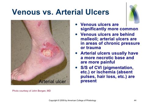 It is a wound that occurs when the leg veins don't return blood back toward the heart the way they should. 20110113 Speakers Bureau Revised