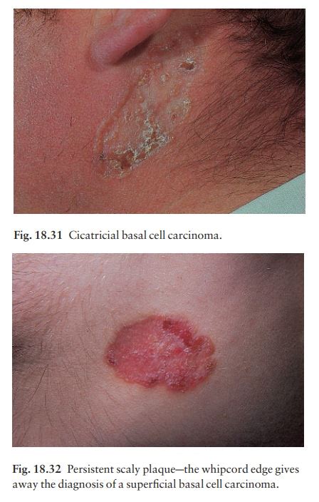 Basal Cell Carcinoma Rodent Ulcer