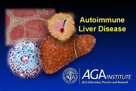 Title Slide Autoimmune Liver Disease Definition Psc Primary