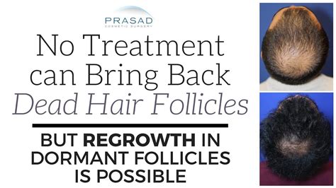 Why No Treatment Can Revive Dead Hair Follicles But Regrowth Of