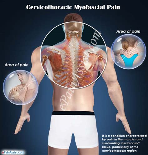 Cervicothoracic Myofascial Paincausessymptomstreatmentexercises And Pt