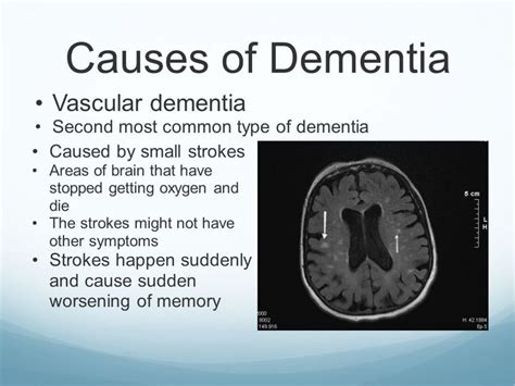 Vascular Dementia Symptoms And Signs Images Result Samdexo