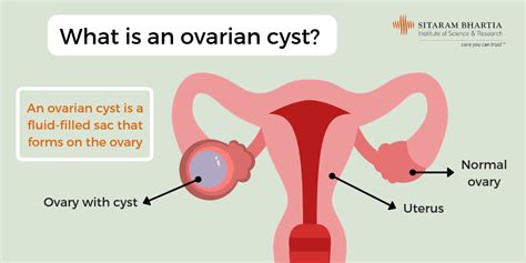 Ovarian Cyst Size Comparison Chart