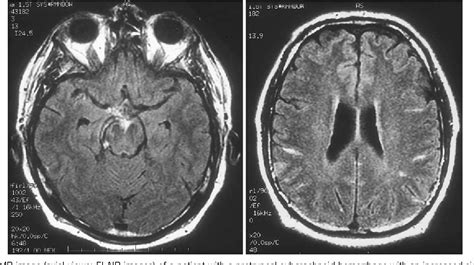 Figure 1 From Mr Imaging In Pretruncal Nonaneurysmal Subarachnoid