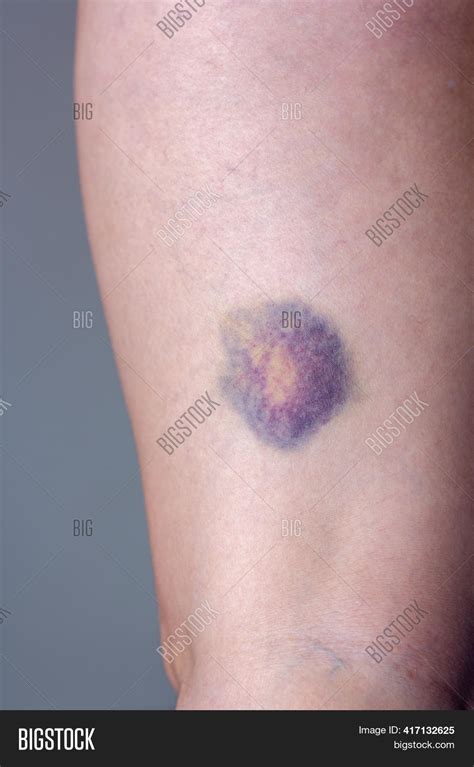 Large Round Bruise On Image And Photo Free Trial Bigstock