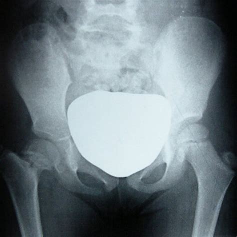 Anteroposterior Radiograph Of The Pelvis Showing The Valgus Osteotomy