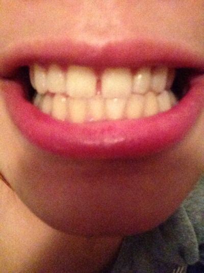 Gappy teeth are quite common, but sometimes #4 how to fix your teeth gaps at home safely. How long would it take for my front teeth gap to close if ...