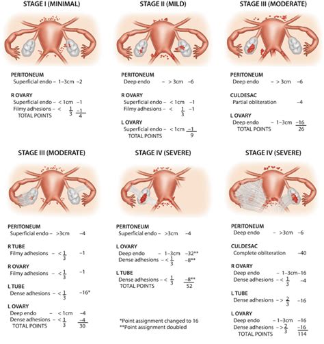 Endometriosis — Dr Praveen De Silva Gynaecologist