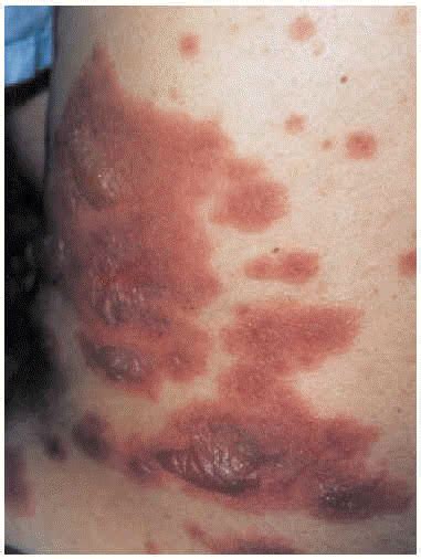 Stevens Johnson Syndrome Associated With Atypical Pneumonia Archivos