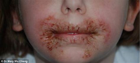 The Horrific Damage Baby Wipes Can Do To Childrens Skin Chemical In