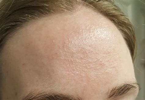 Red Bumps On Forhead
