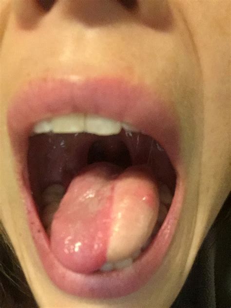 woman s tongue replaced with thigh to fight cancer