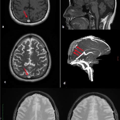 Subacute Thrombus Of The Superior Sagittal Sinus A B Axial And