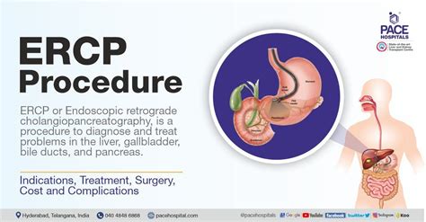 Ercp Procedure In Hyderabad Indications Surgery Cost And Treatment