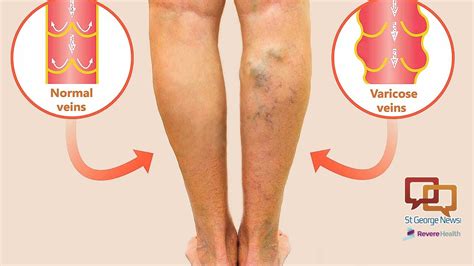 The Dangers Of Varicose Veins St George News