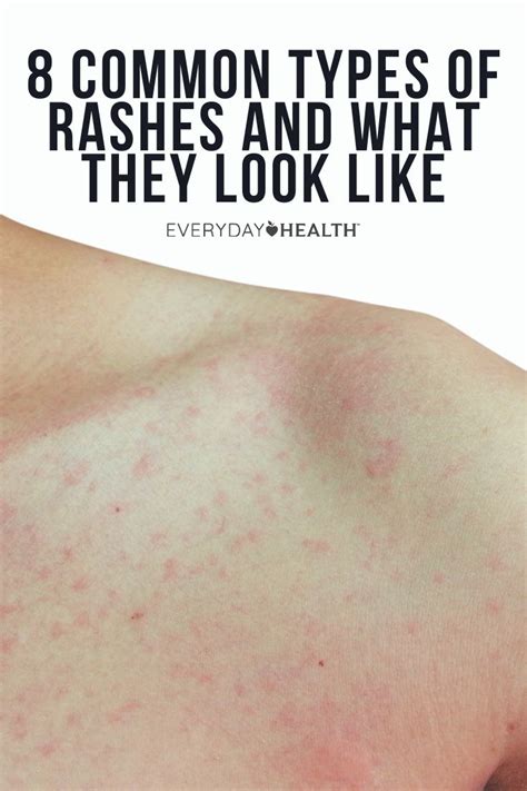 Common Types Of Rashes And What They Look Like In Rashes Heat Rash Remedy Types Of Rashes