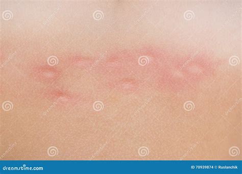 Mosquito Bites On Skin Stock Photo Image Of Pimple Allergy 70939874