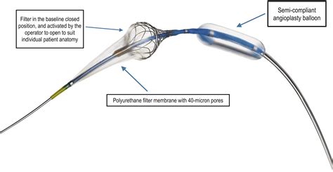 Double Filtration During Carotid Artery Stenting Using A Novel Post
