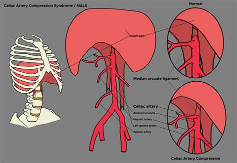 Figure Illustration Of Celiac Artery Compression Statpearls