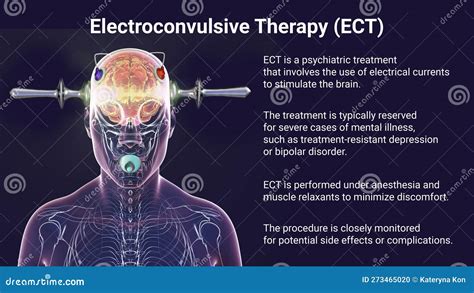 Electroconvulsive Therapy Ect A Treatment Used For Severe Mental