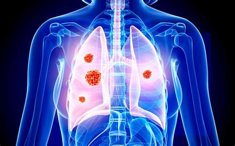 Non Small Cell Lung Cancer Women Live Longer Than Men • Healthcare In